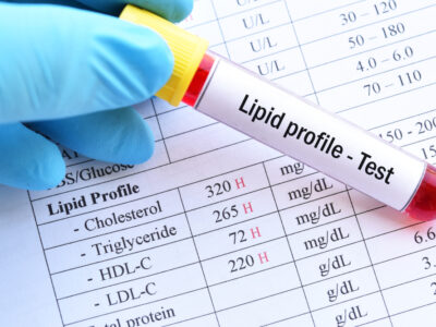 Lipid test tube and results close up