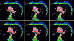 Multiple images of a heart from a cardiac ct scan
