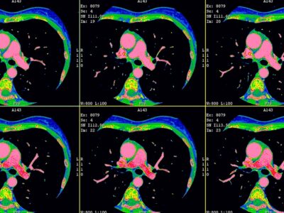 Multiple images of a heart from a cardiac ct scan