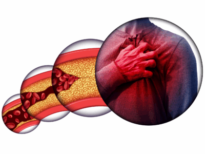 Animated view with 3 circular portraits of a clogged artery leading to a man gripping his chest with heart pain or failure.
